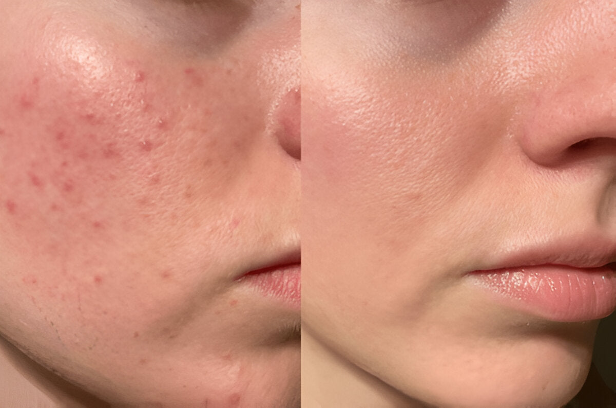 Before and after comparison of a person's face with acne on the left and clear skin on the right.