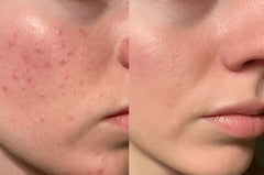 Sugav® Salicylic Acid Gel Face Wash